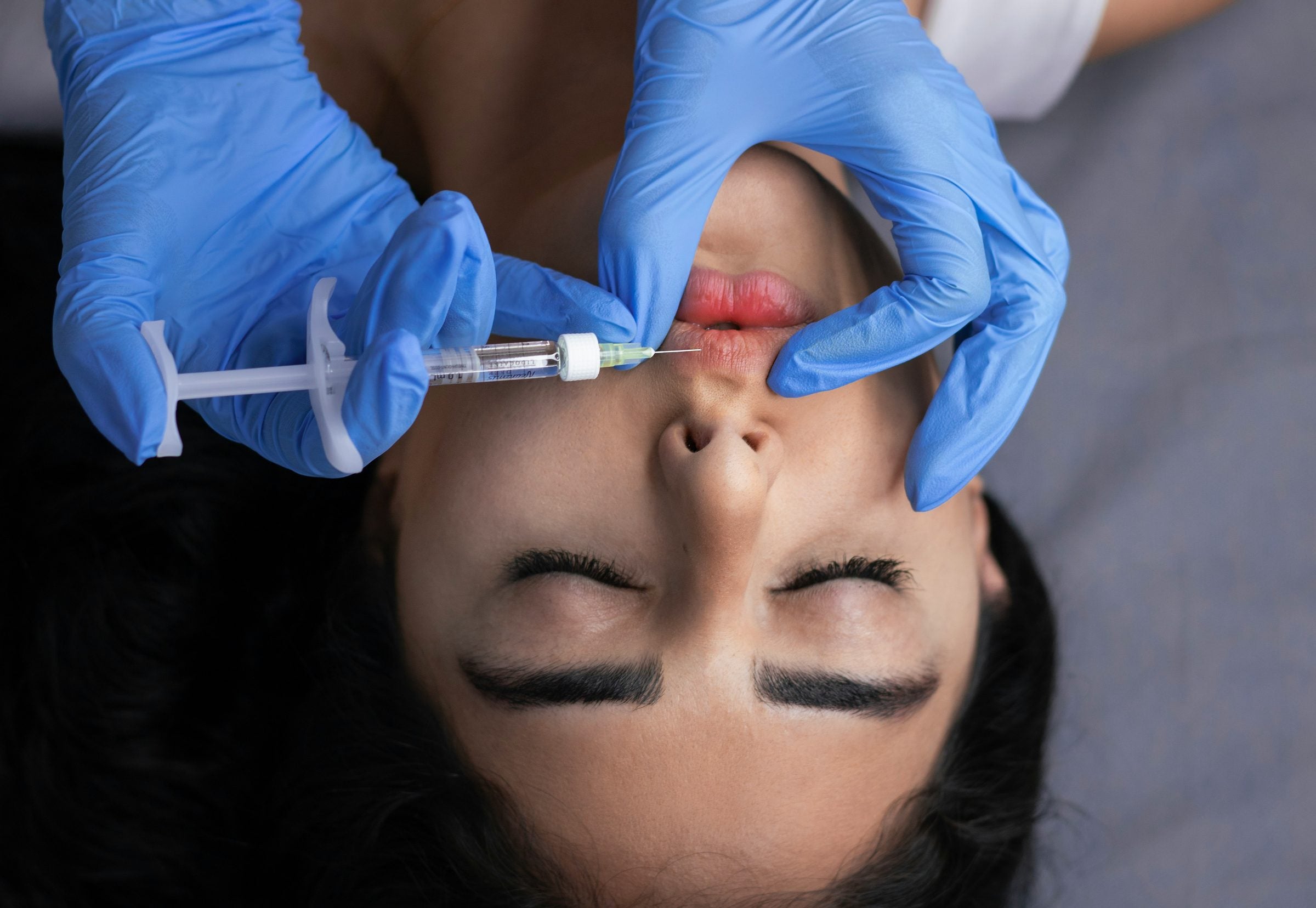 Dermal Fillers treatment at Milan Medical