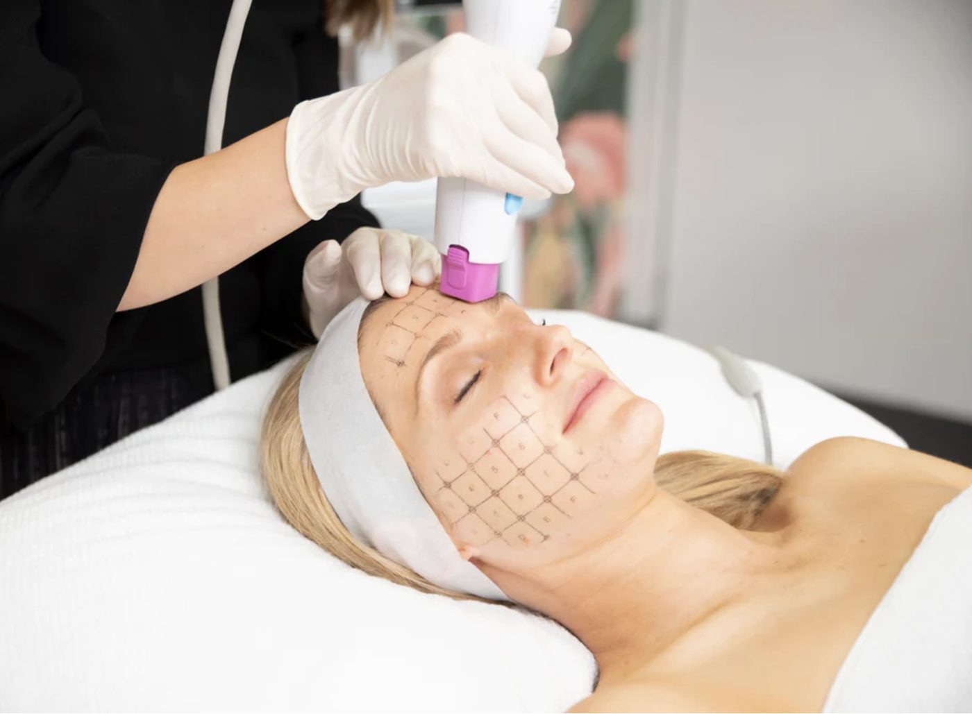 Thermage & Ultherapy treatment at Milan Medical